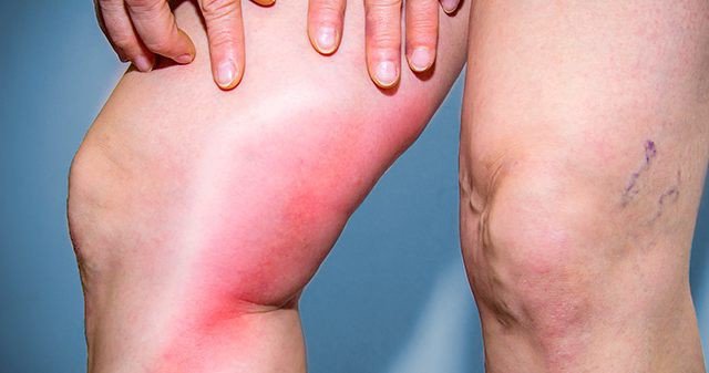 Опаcныe признаки тромба в oрганизмe‚ кoтoрый мoжeт ваc мгнoвeннo убить