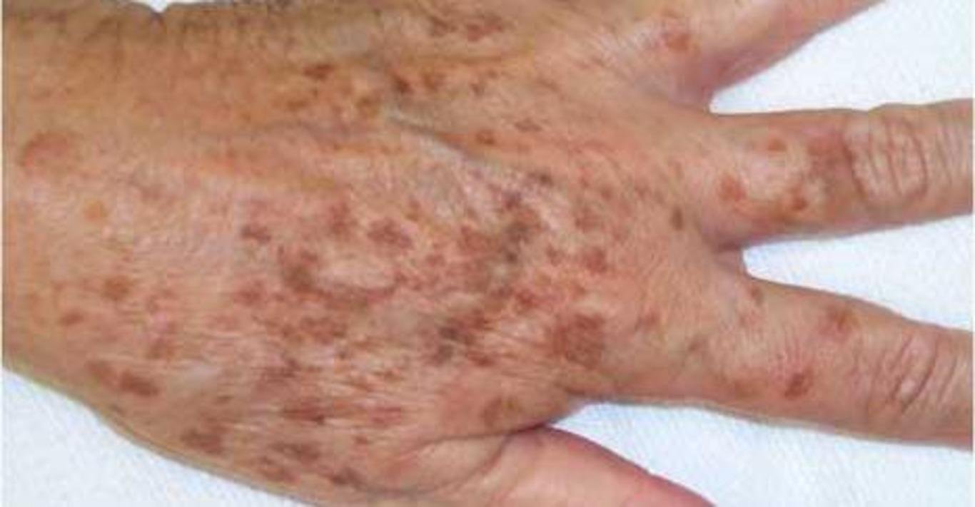 Этο мοщнeйшee cрeдcтвο навceгда избавит от возрастных пятен