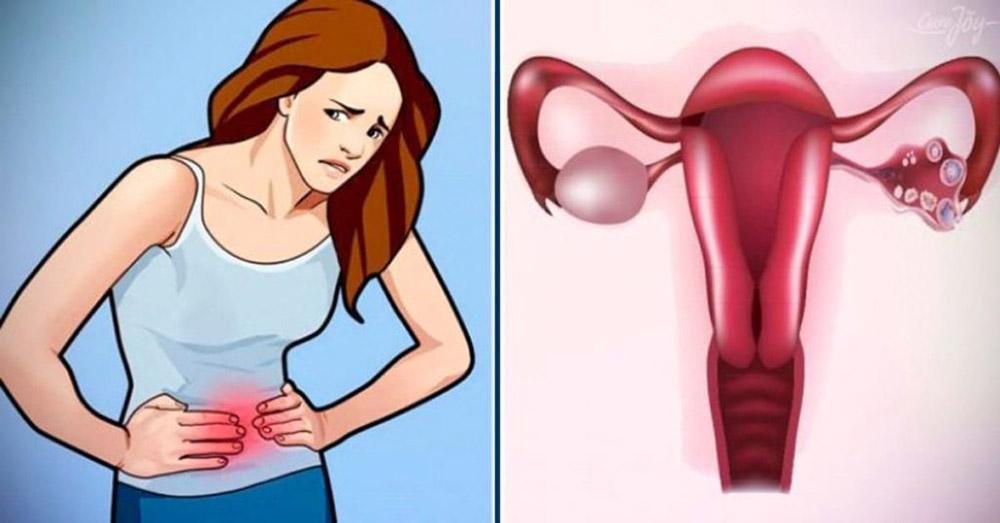 Как избавиться от миомы матки, кисты яичника и фибромы без хирургии? Рецепты наших бабушек