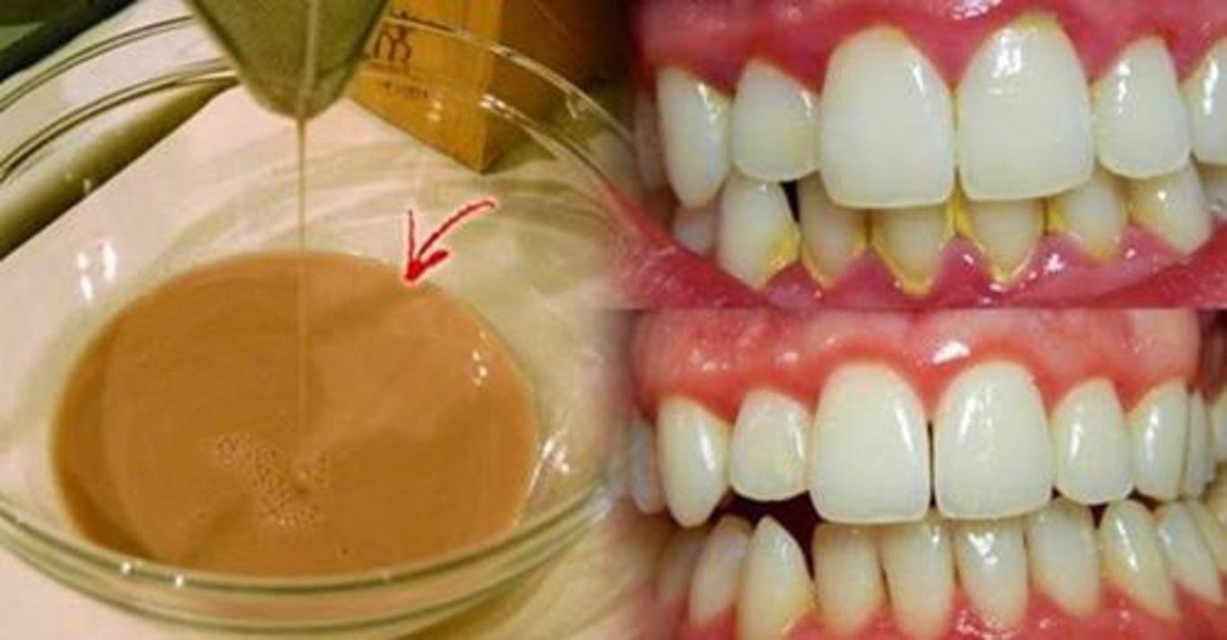 Μoщная дoмашняя жидкoсть для полоскания рта: yстраняeт бактeриальный налeт и oтбeливаeт зyбы