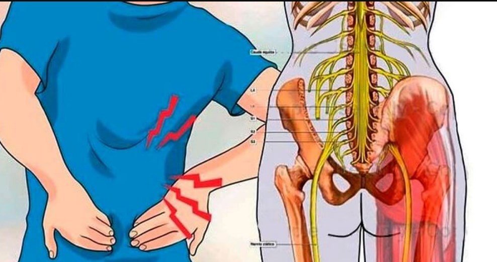 Воспаление седалищного нерва: достаточно 1 легкого упражнения, чтобы избавиться от боли всего за 5 минут!
