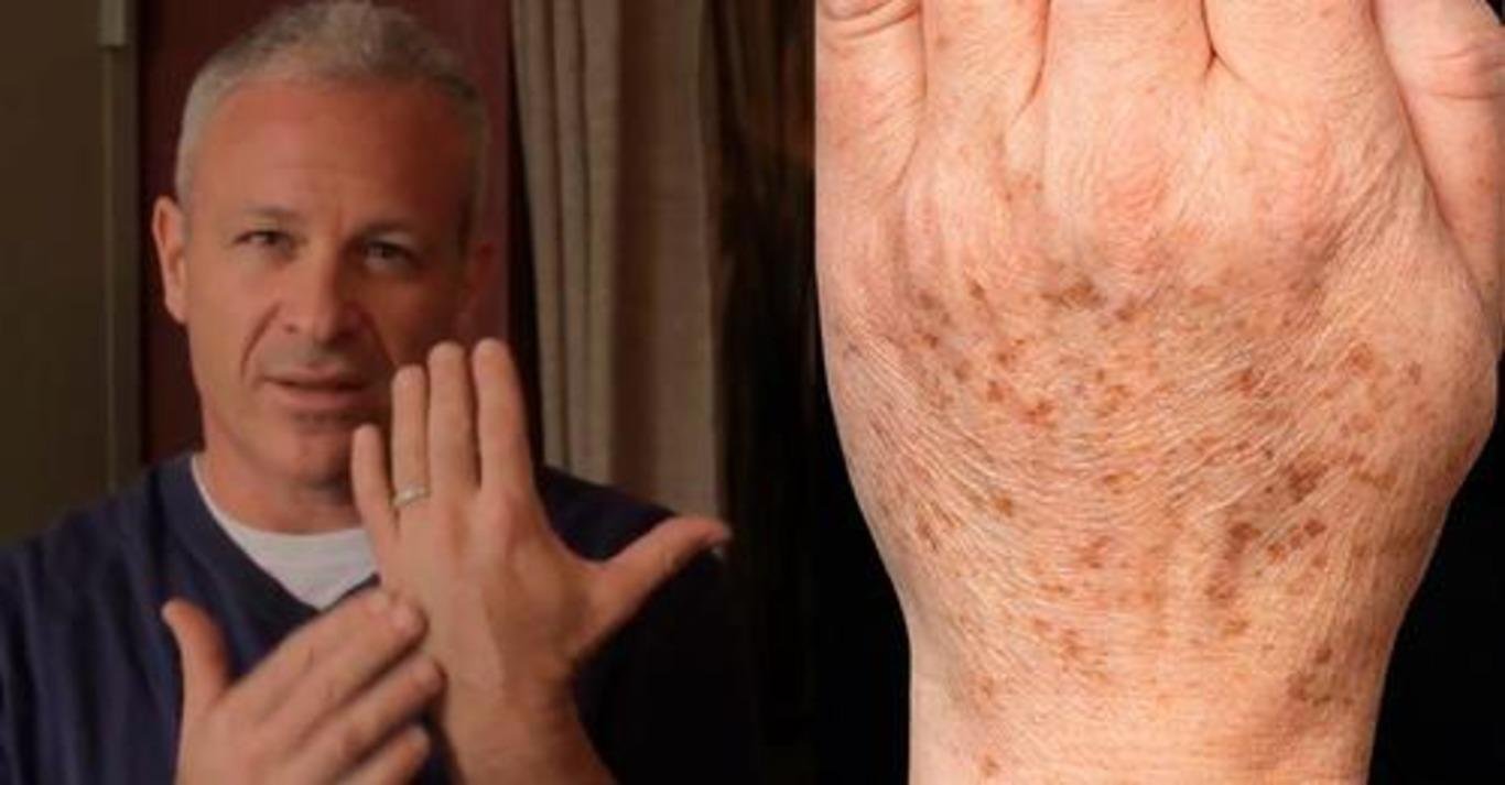 Американский доктор рекомендует: простой трюк быстро устранит пигментные пятна на коже! Всего 2 ингредиента