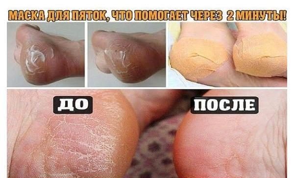 Бабушка показала мне этот трюк. Это исцелило меня от потрескавшихся пяток всего за одну ночь