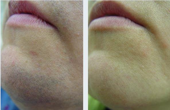 Древний русский рецепт поможет избавиться от волос навсегда!