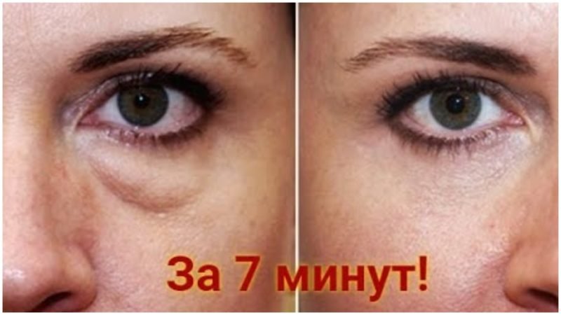 Экспресс-метод, позволяющий избавиться от отеков и мешков под глазами, не заплатив ни копейки