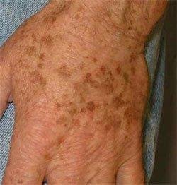 Боремся с нежелательной пигментацией. Вам понадобятся всего 2 ингредиента, которые есть в каждом доме!