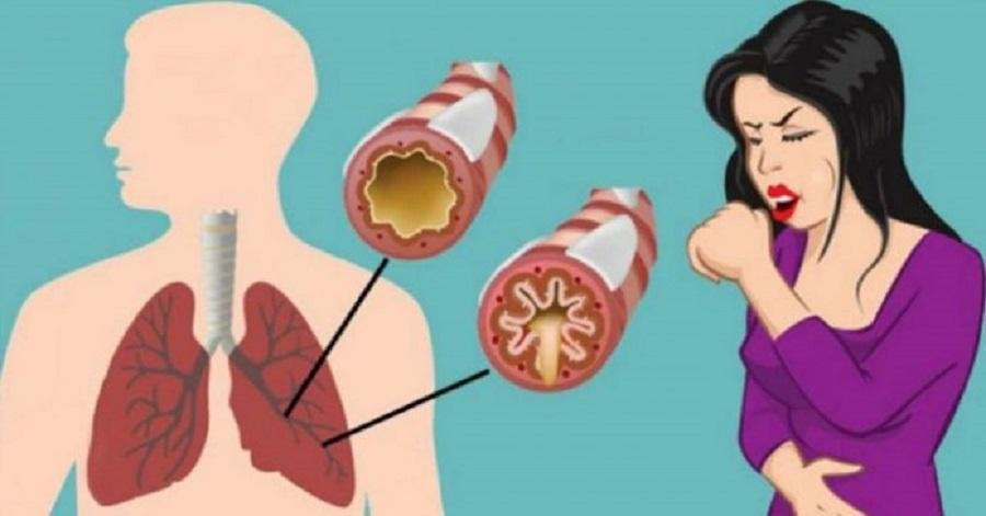 Как устранить слизь и мокроту из горла и груди (мгновенный результат)
