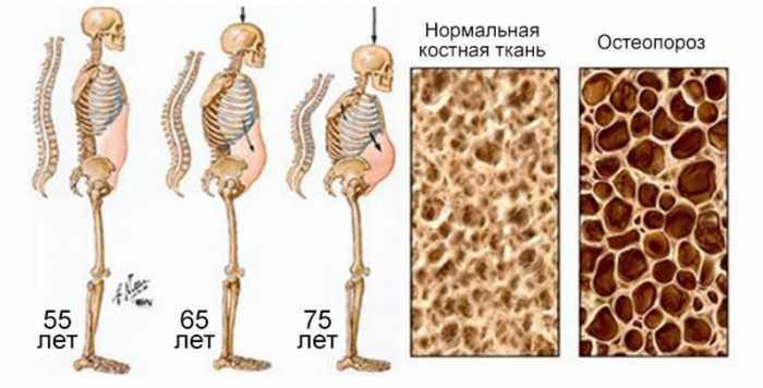 Этот напиток разрушает кости изнутри, но люди продолжают употреблять его