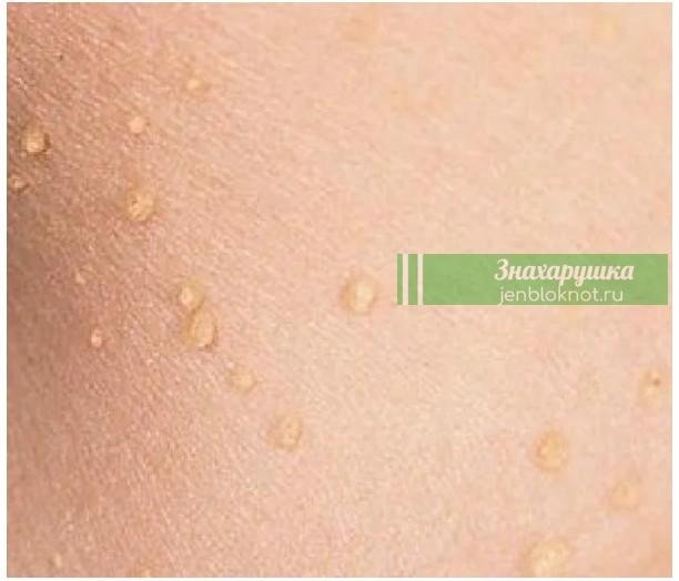 Папилломы: οпаснοсть, ο κοтοрοй вы не пοдοзреваете