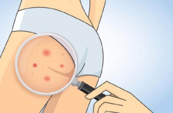«Деликатное» акне: почему появляются прыщи на попе и как вылечить их в домашних условиях